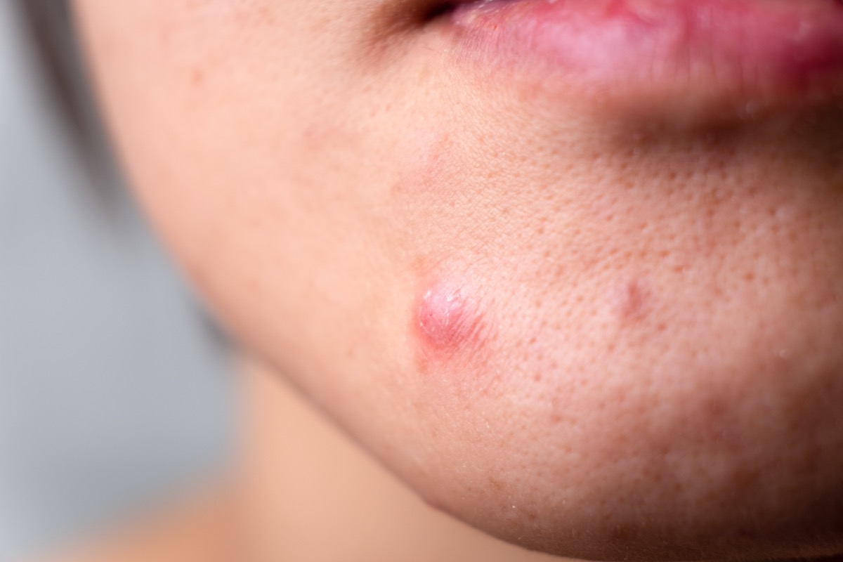 close-up-of-a-person-s-skin Facial acne lesion with early scarring, acne scar consultation in Claremont CAv
