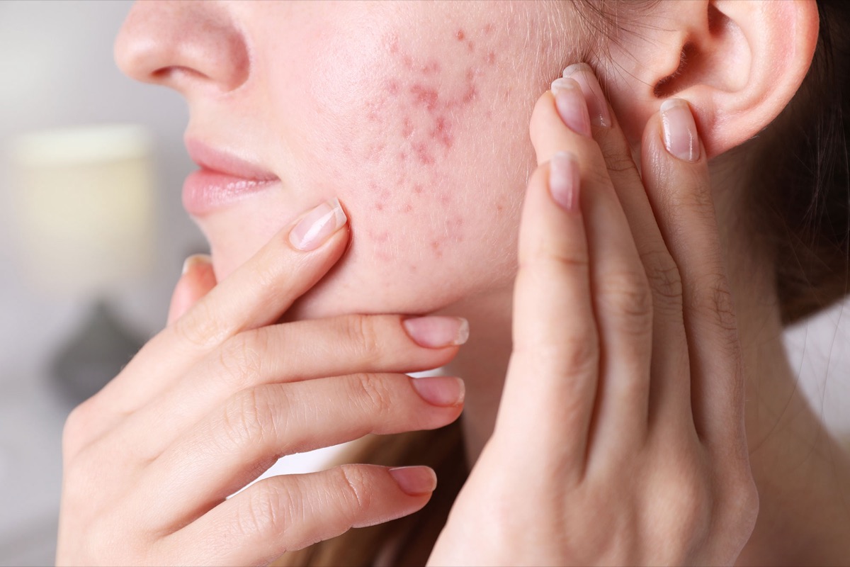 woman-examining-facial-blemishes-in-close-up-shot-2026-04-23-17-03-45-utc Close-up of active acne breakouts on cheek with inflammation and early acne scarring, acne scar treatment Claremont